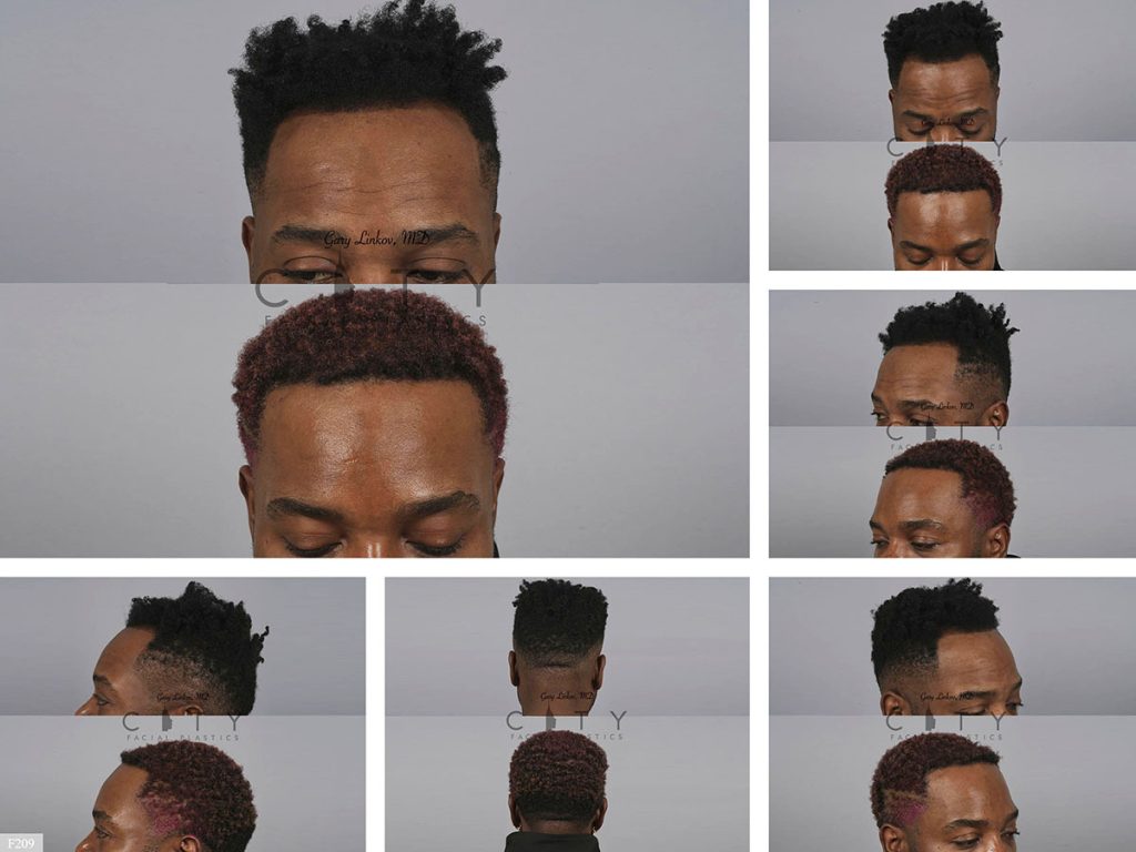 Hair Transplant F209