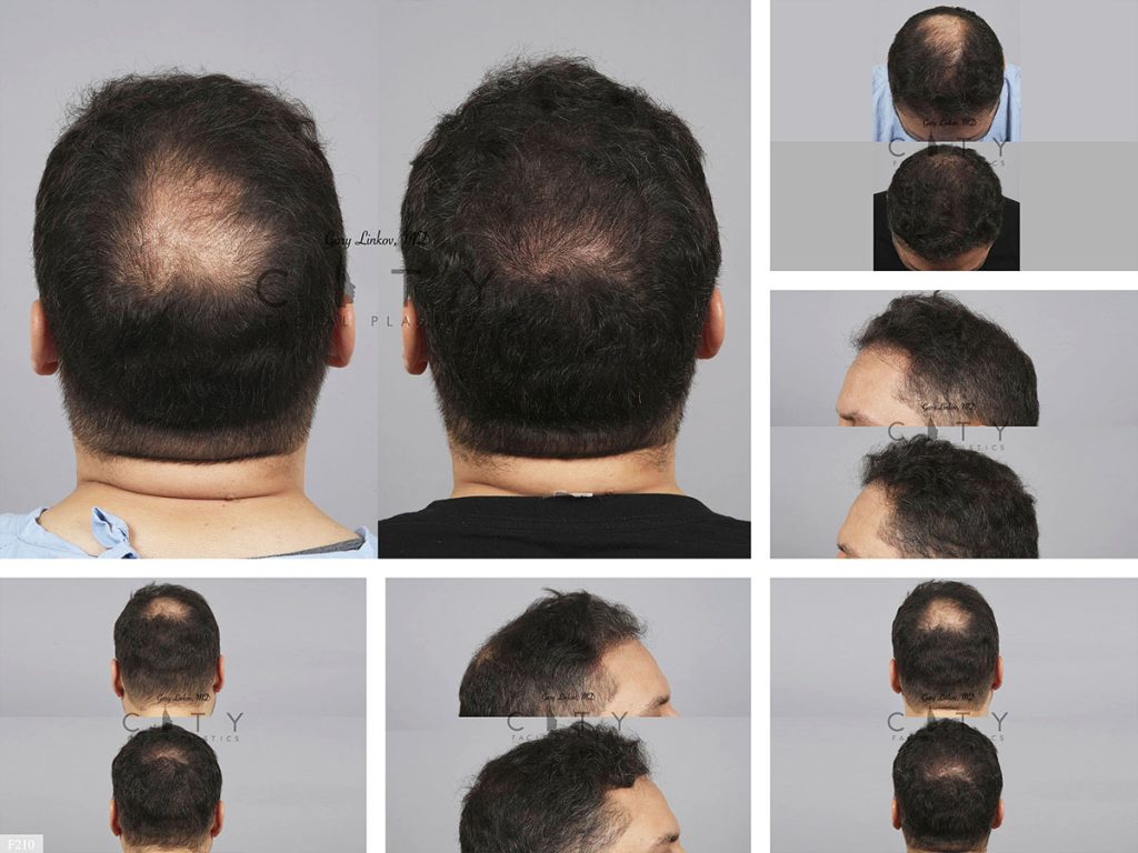 Hair Transplant F210