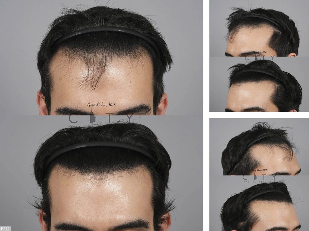 Hair Transplant F211