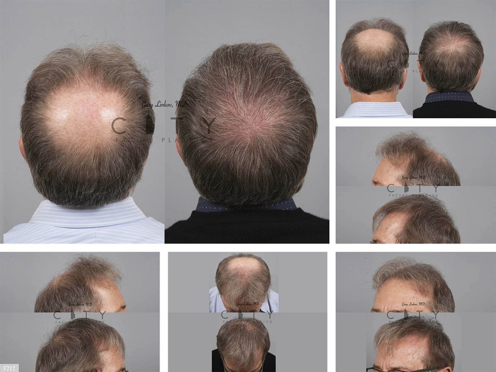 Hair Transplant F212