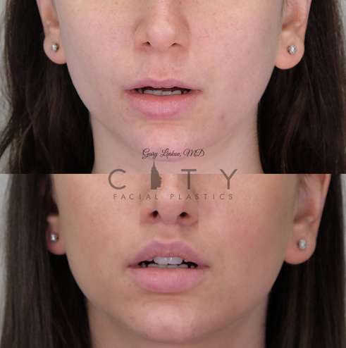 Bullhorn-Lip-Lift-14-case-1-front-mouth-open