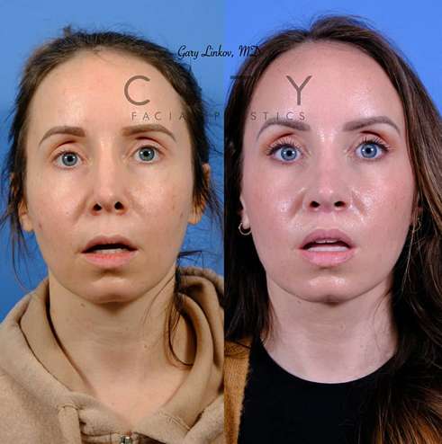 Lip-lift-52-case-7-frontal-mouth-open