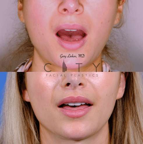 Lip-lift-62-case-5-frontal-mouth-open