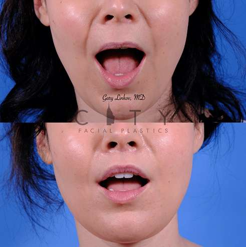 Lip-lift-63-case-8-frontal-mouth-open