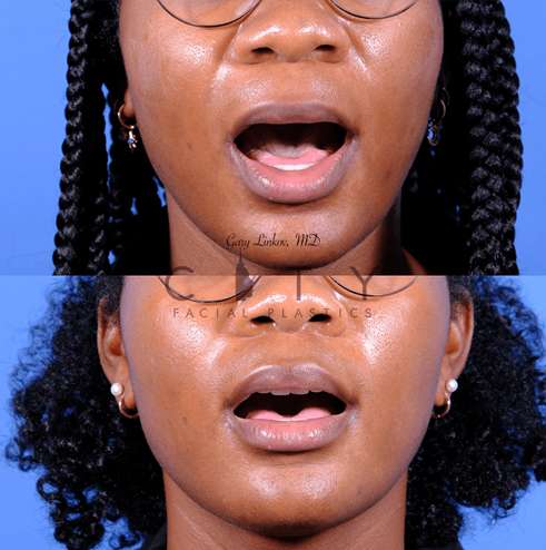 3 months after elelyft ethnic lip lift to reduce the philtrum, without distorting natural lip aesthetics