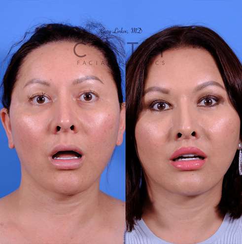 Frontal, 5 months after an elelyft lip lift in NYC