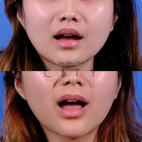 Front view, 3 months post reshaping and tweaking lip in NYC