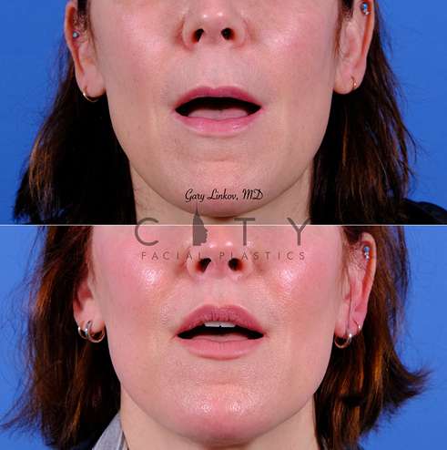 Lip lift 86 frontal mouth open case 14