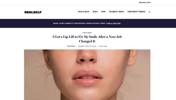 I Got a Lip Lift to Fix My Smile After a Nose Job Changed It