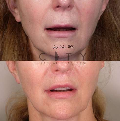 lip-lift-32-case-2-frontal-mouth-open