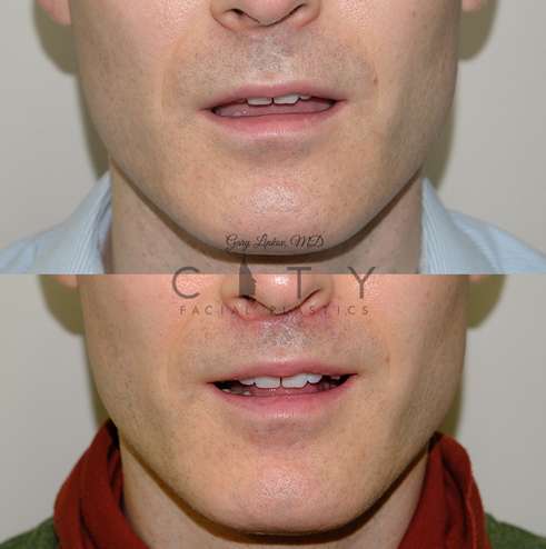 lip-lift-34-case-3-front-mouth-open