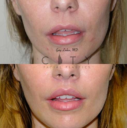 lip-lift-36-case-4-frontal-mouth-open