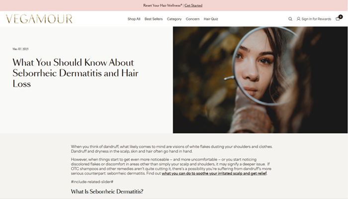 What You Should Know About Seborrheic Dermatitis and Hair Loss