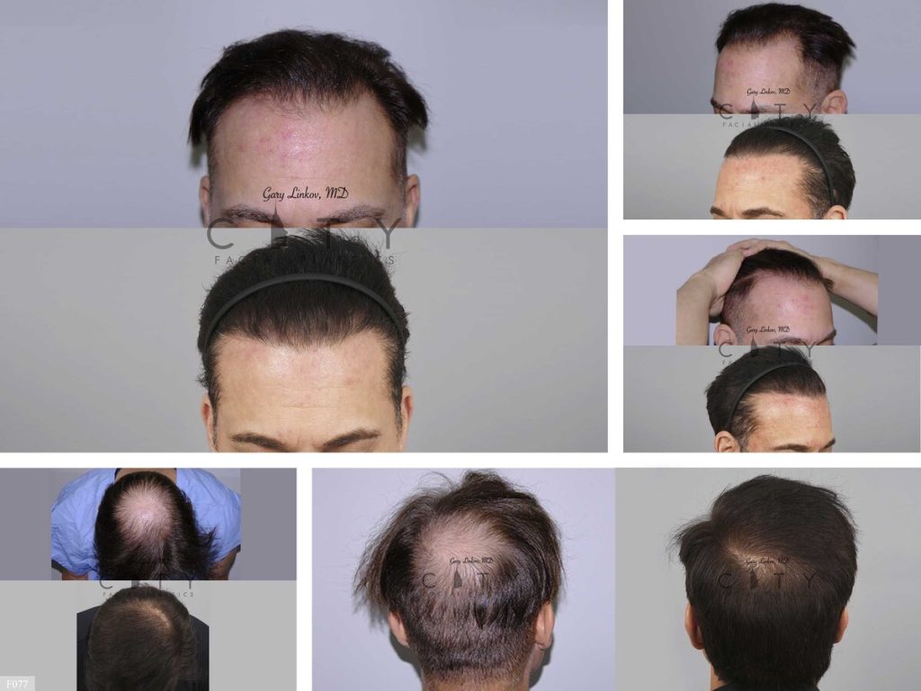 Hair Transplant F077