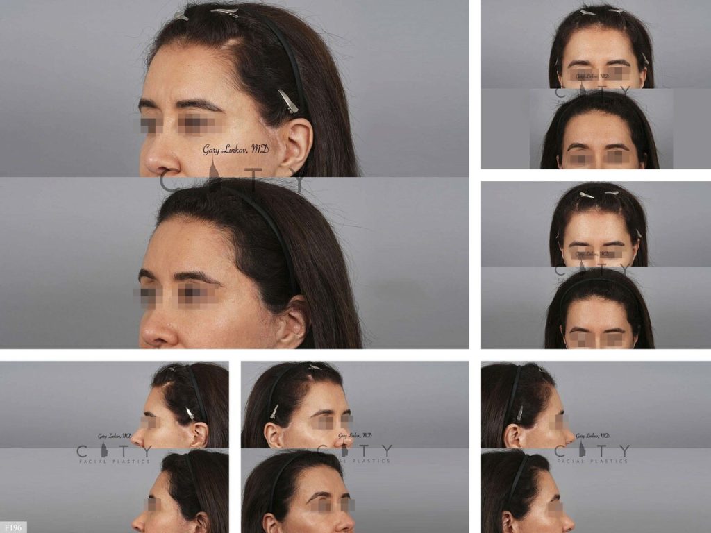 Hair Transplant F196