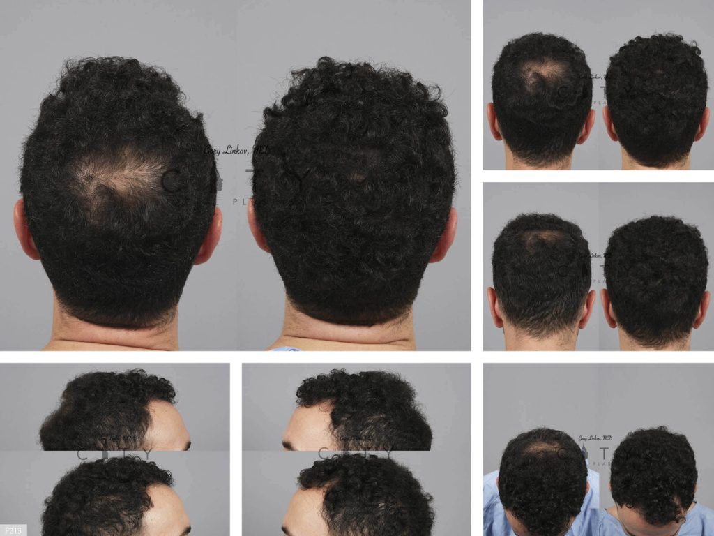 Hair Transplant F213