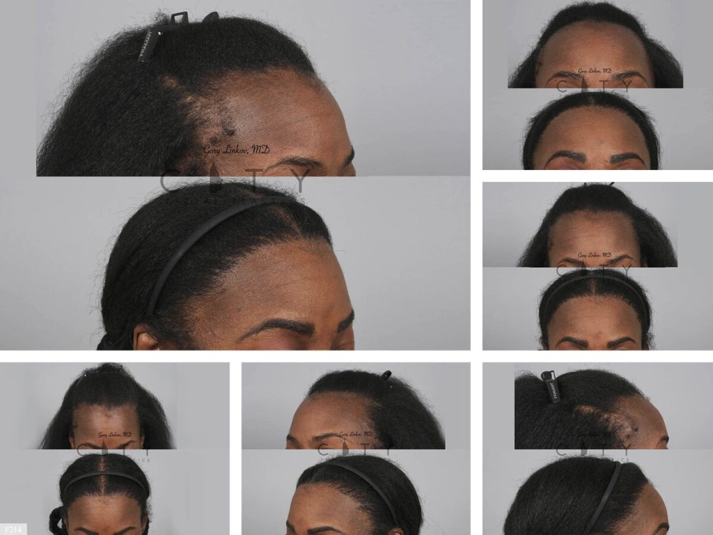 Hair Transplant F214