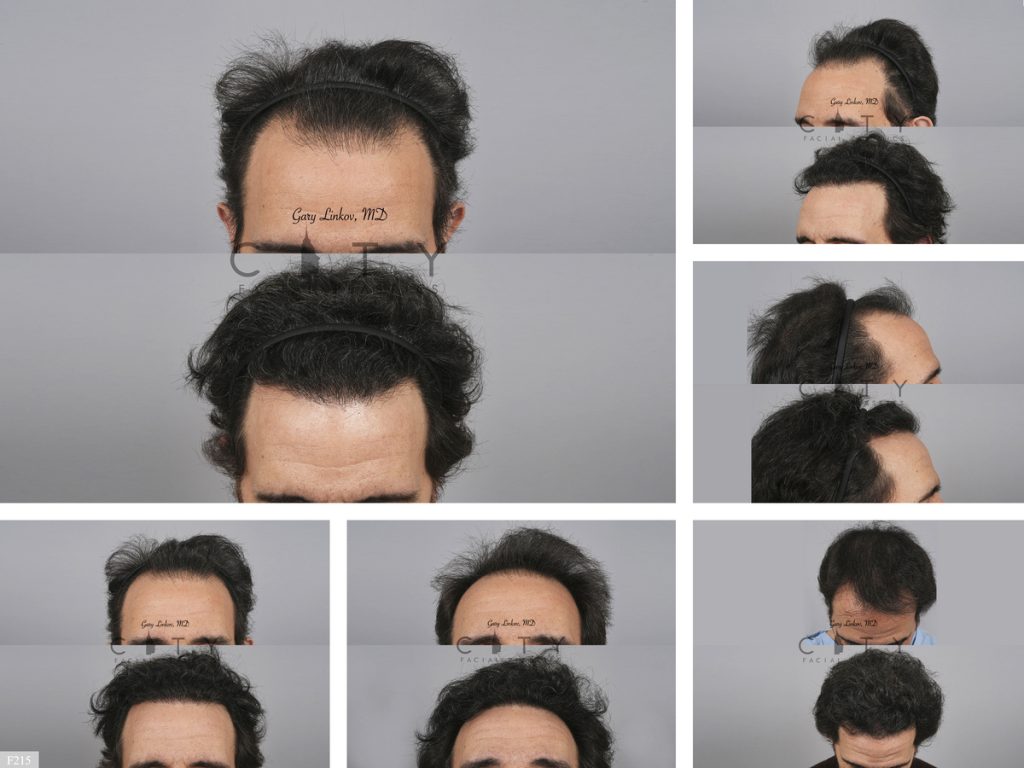 Hair Transplant F215
