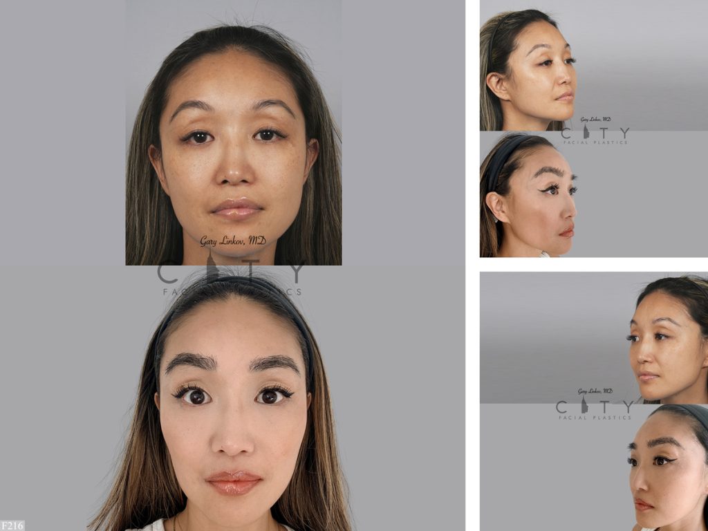 Hair Transplant F216