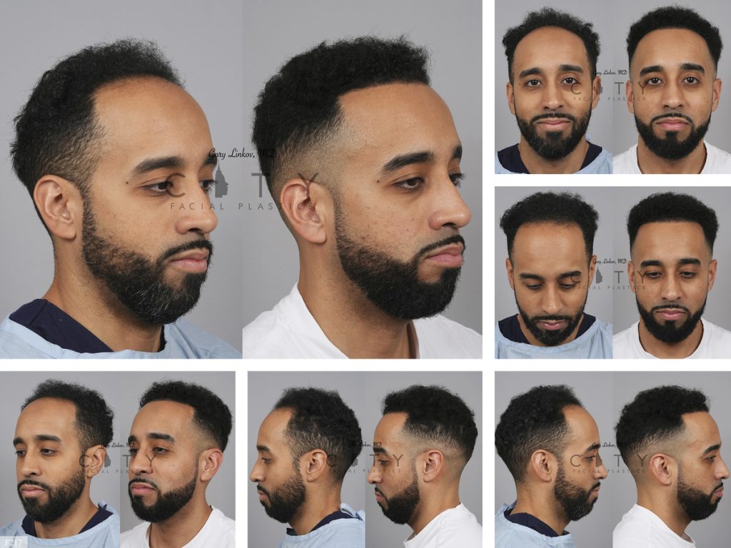 Hair Transplant F217