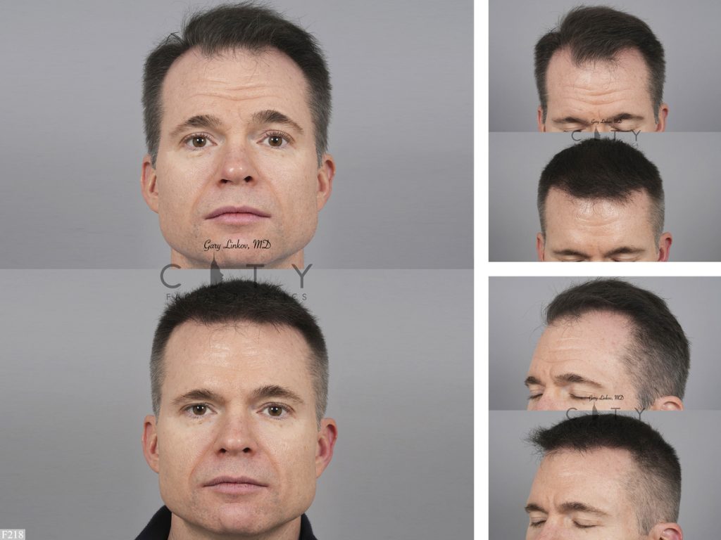 Hair Transplant F218