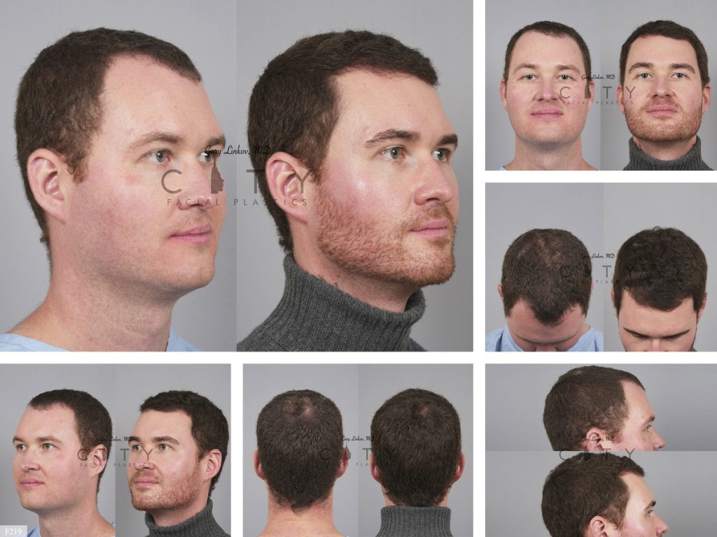 Hair Transplant F219