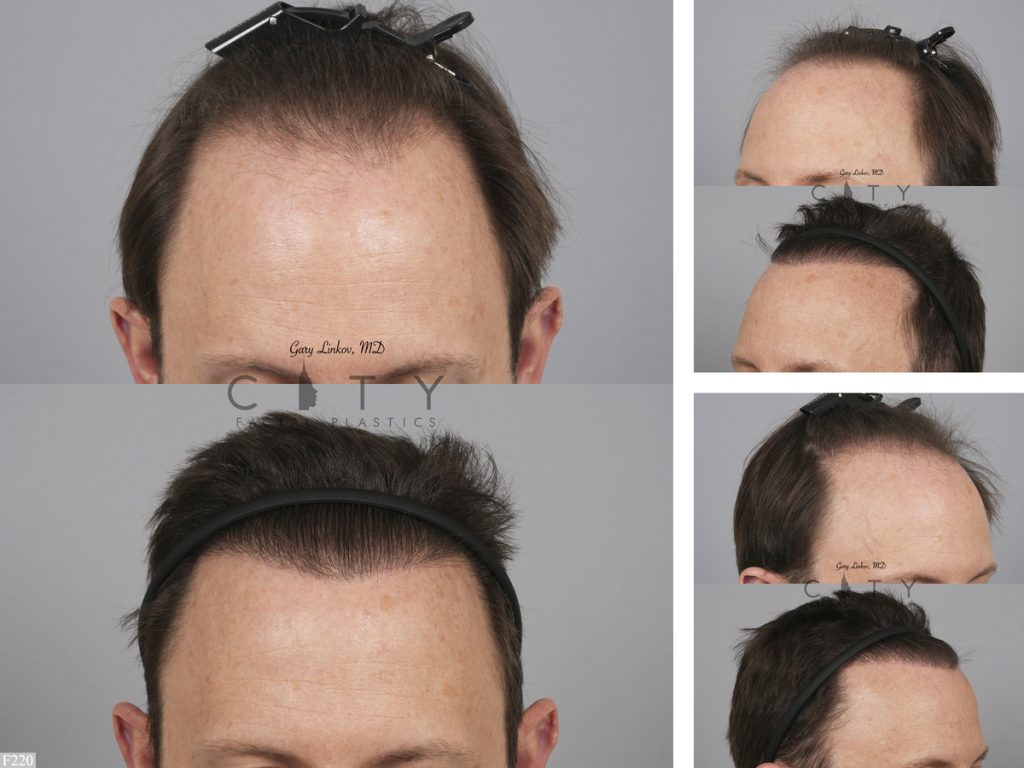 Hair Transplant F220