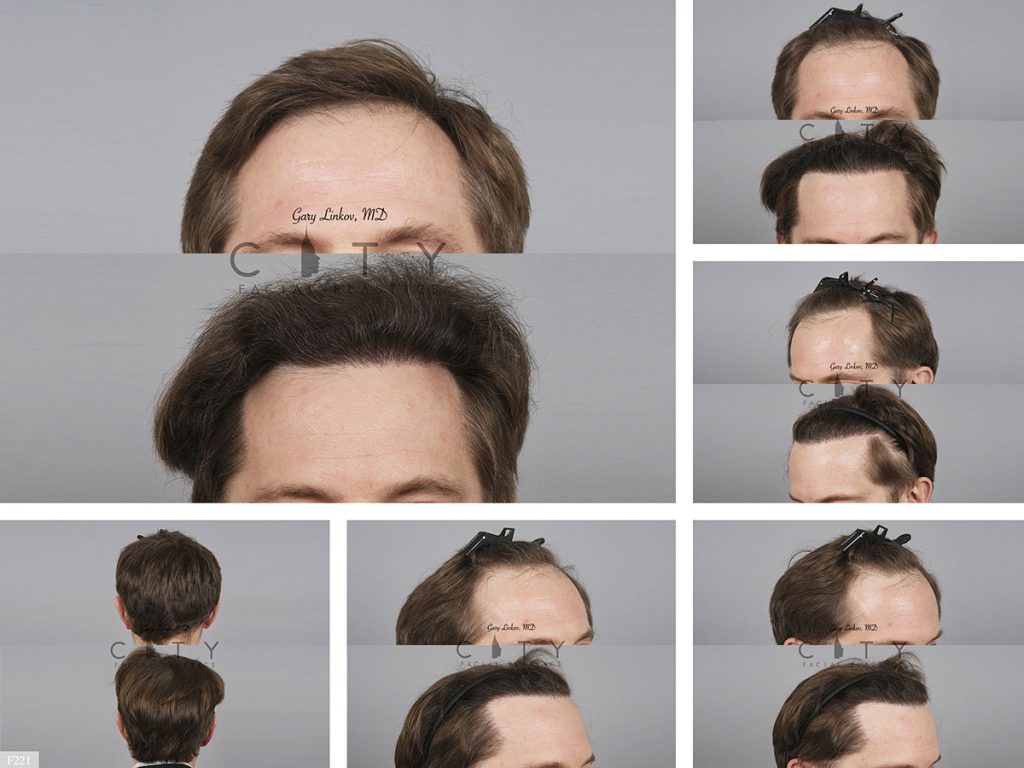 Hair Transplant F221