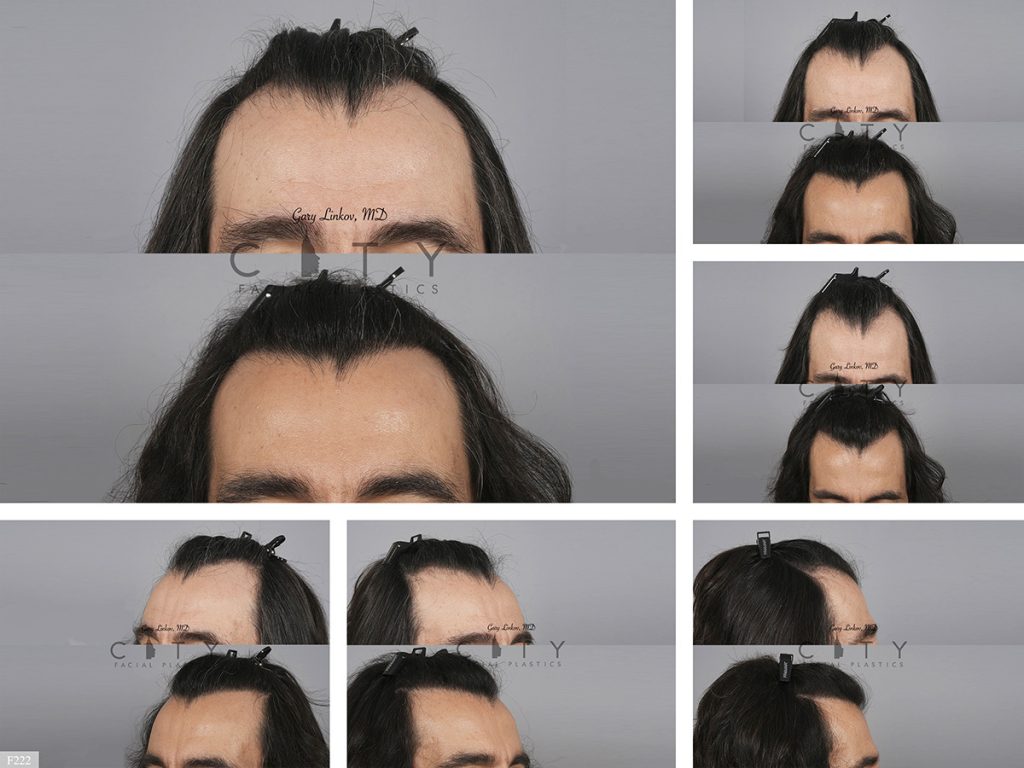 Hair Transplant F222
