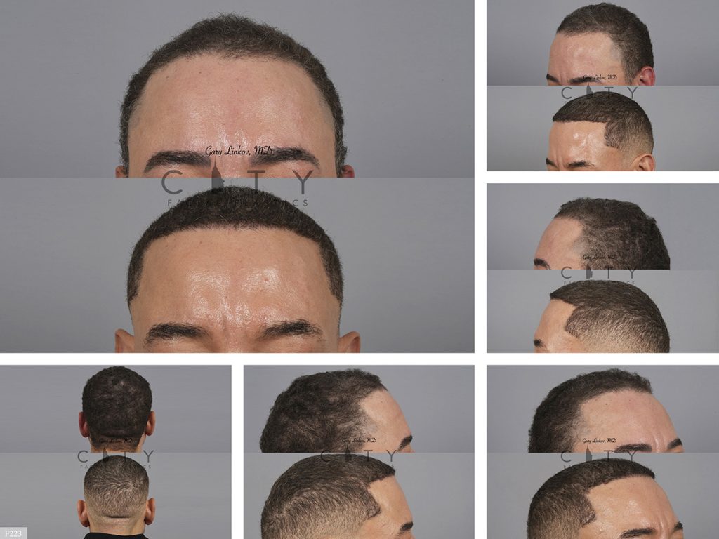 Hair Transplant F223