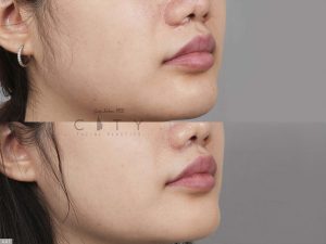Lip Lift G117