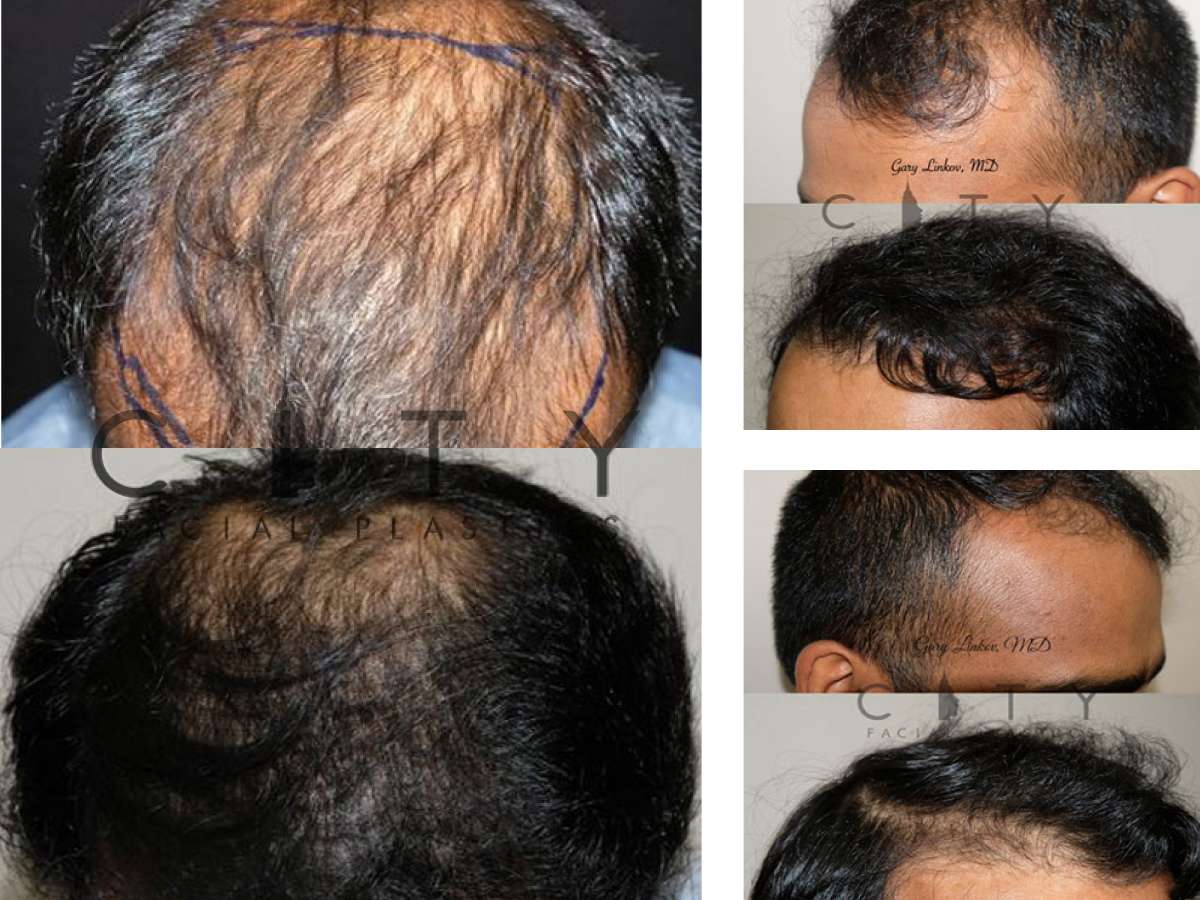 Hair Restoration NYC - Before After Case 4