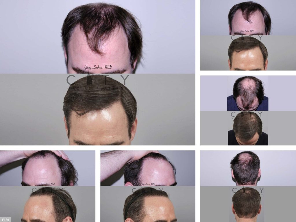 Hair Transplant F130
