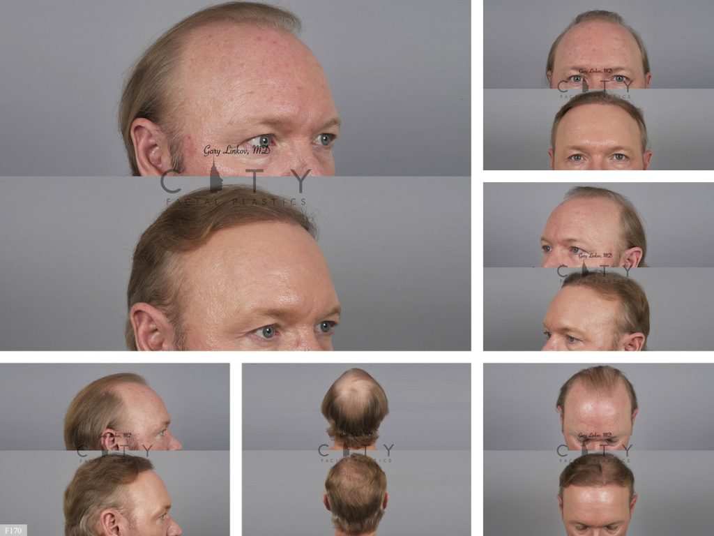 Hair Transplant F170
