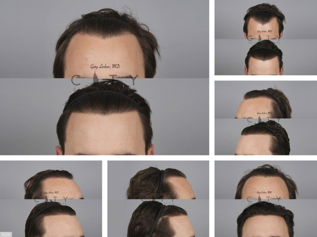 Hair Transplant F224