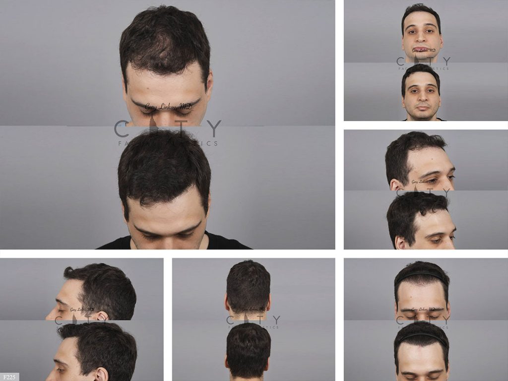 Hair Transplant F225