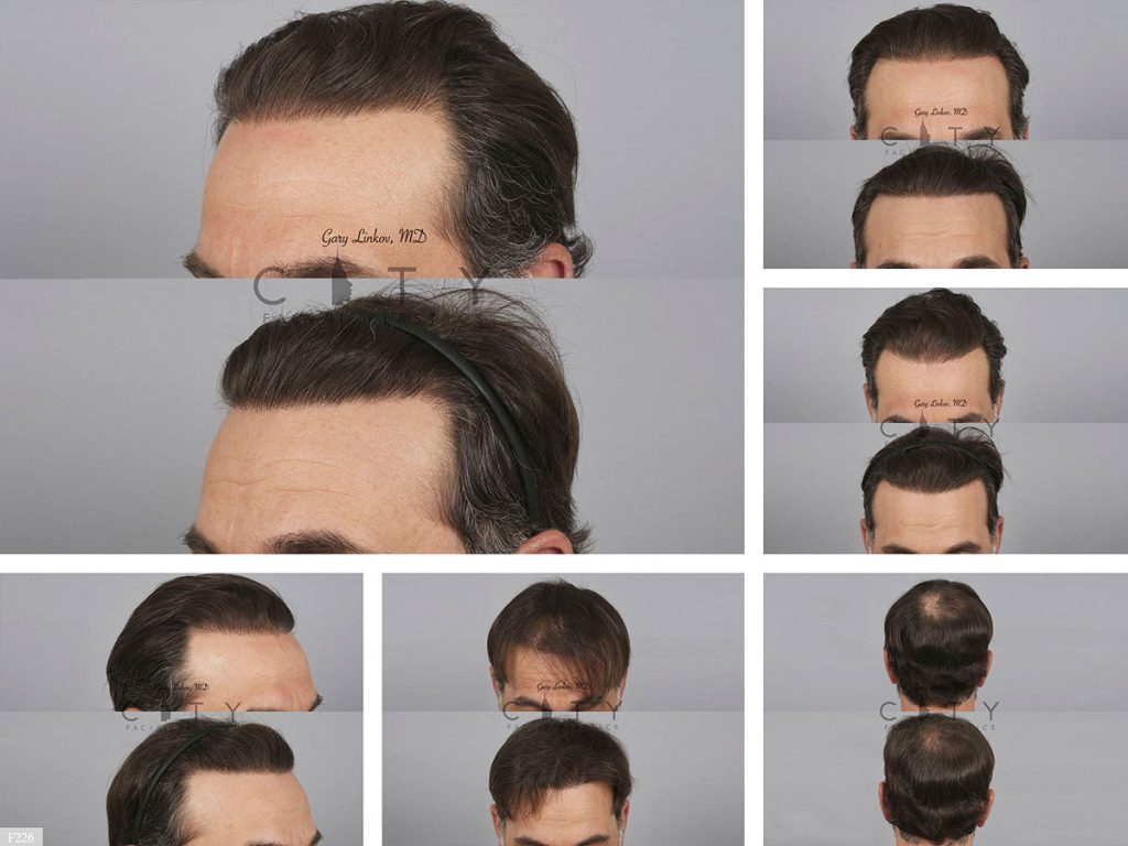 Hair Transplant F226