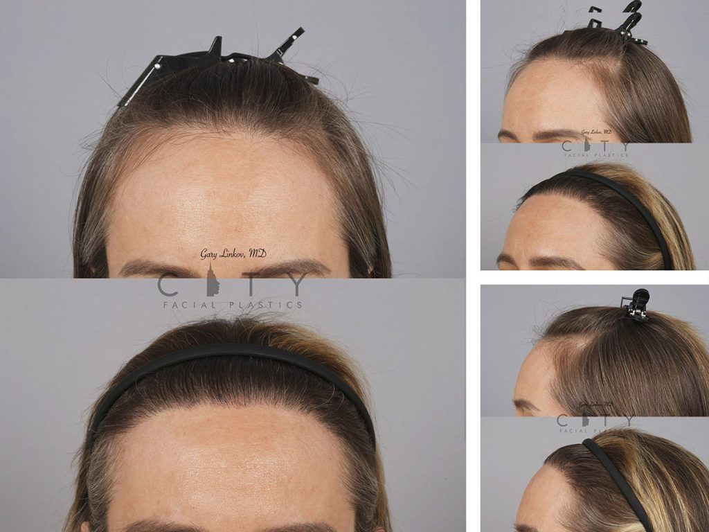 Hair Transplant F227