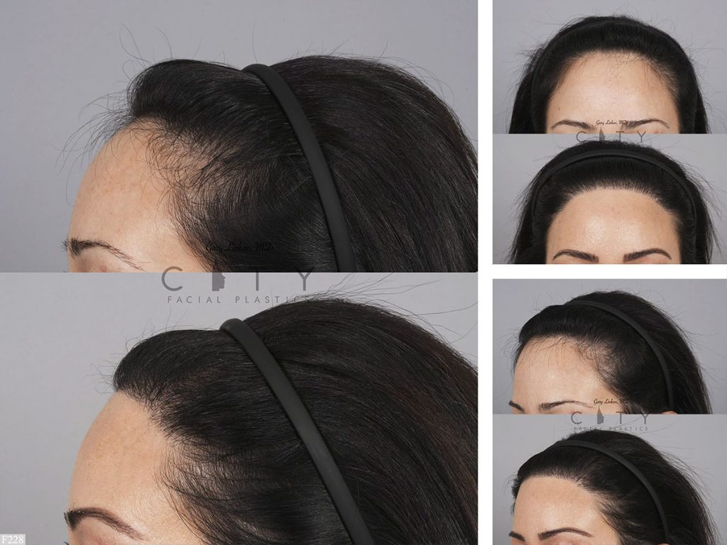 Hair Transplant F228
