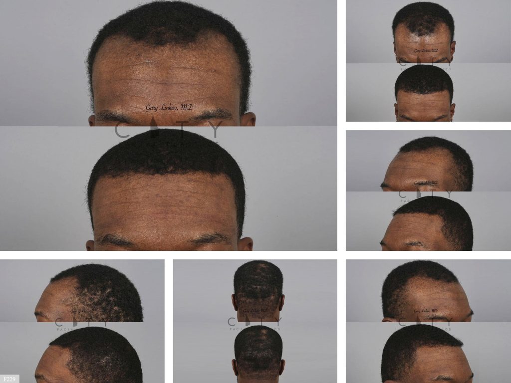 Hair Transplant F229