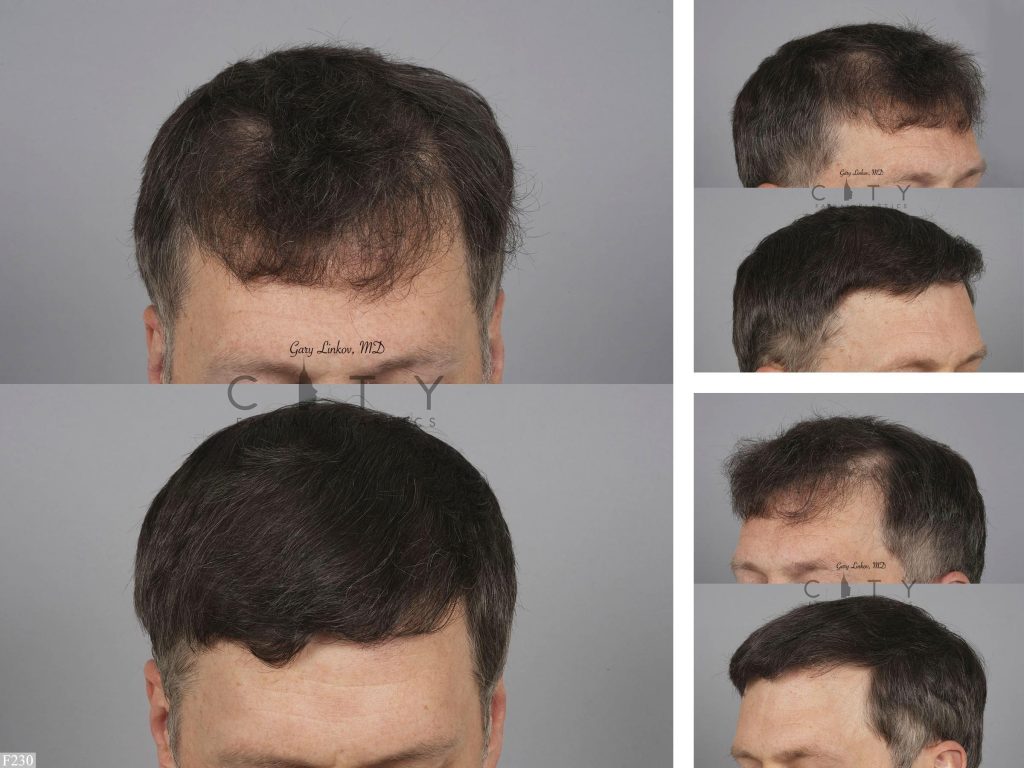 Hair Transplant F230