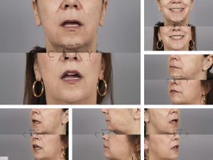 Lip Lift G120