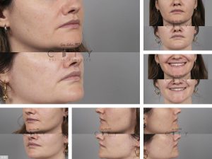 Lip Lift G121