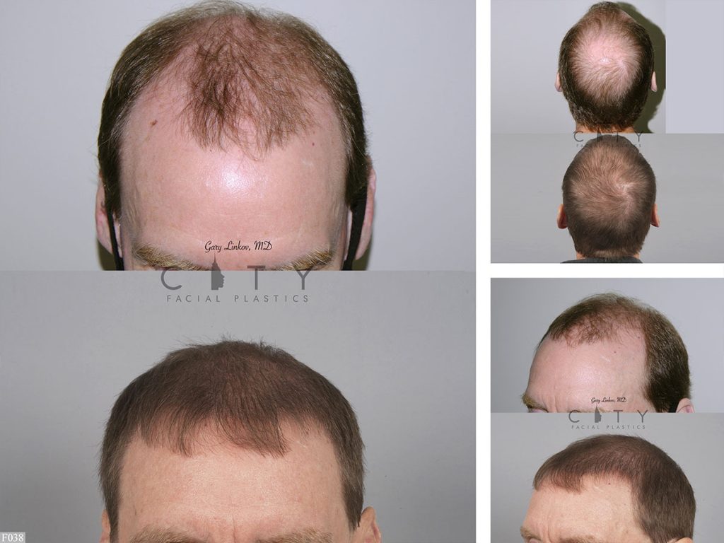 Hair Transplant F038