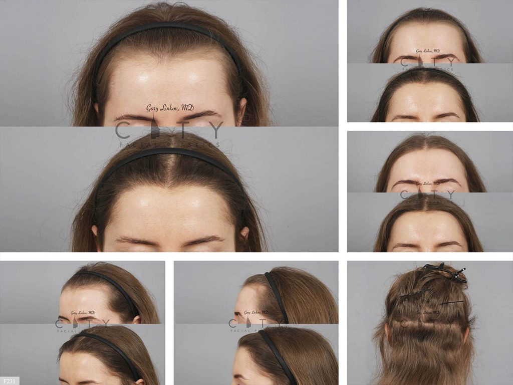 Hair Transplant F231