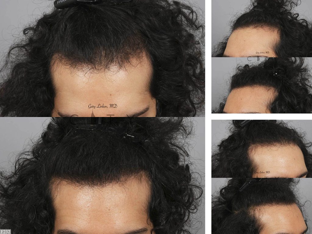 Hair Transplant F232