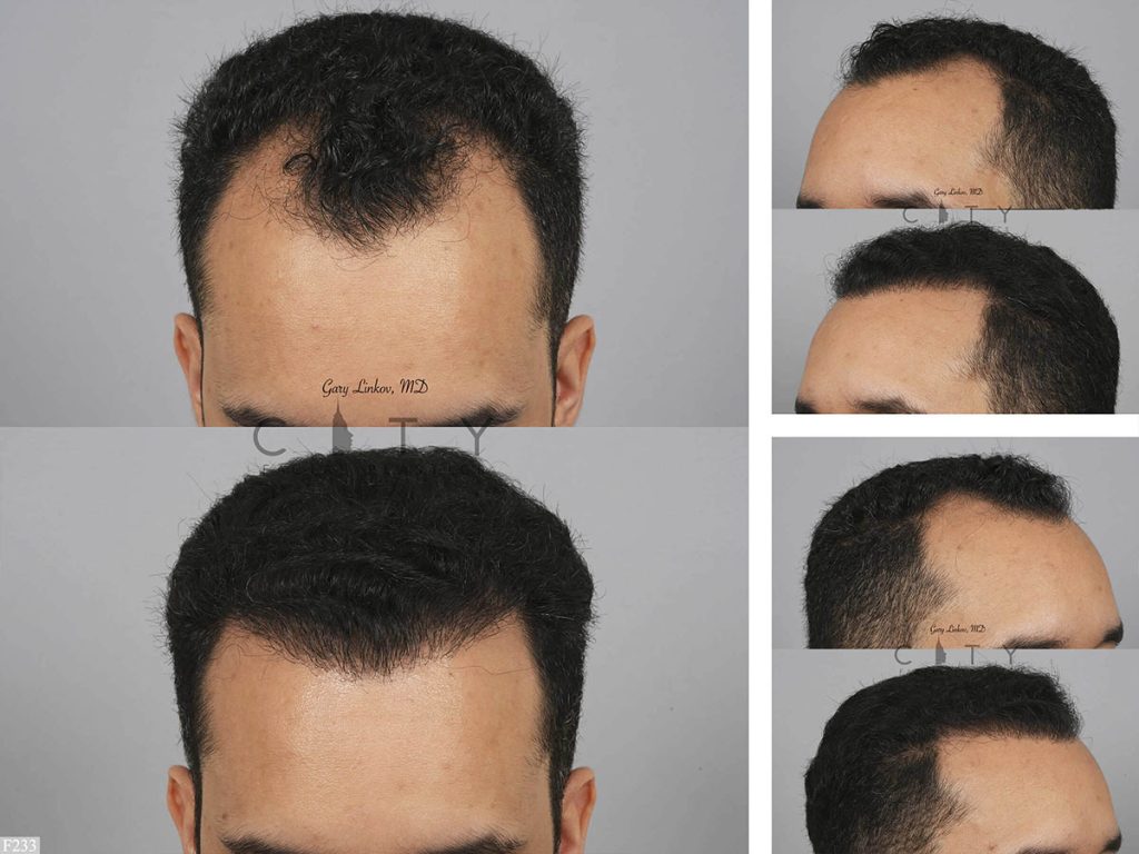 Hair Transplant F233