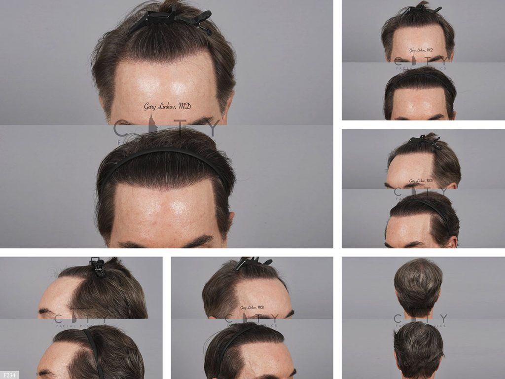 Hair Transplant F234