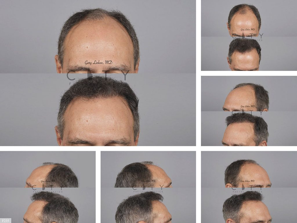 Hair Transplant F235