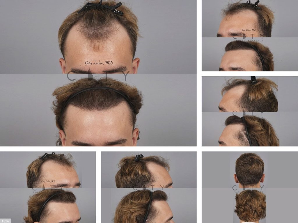 Hair Transplant F236